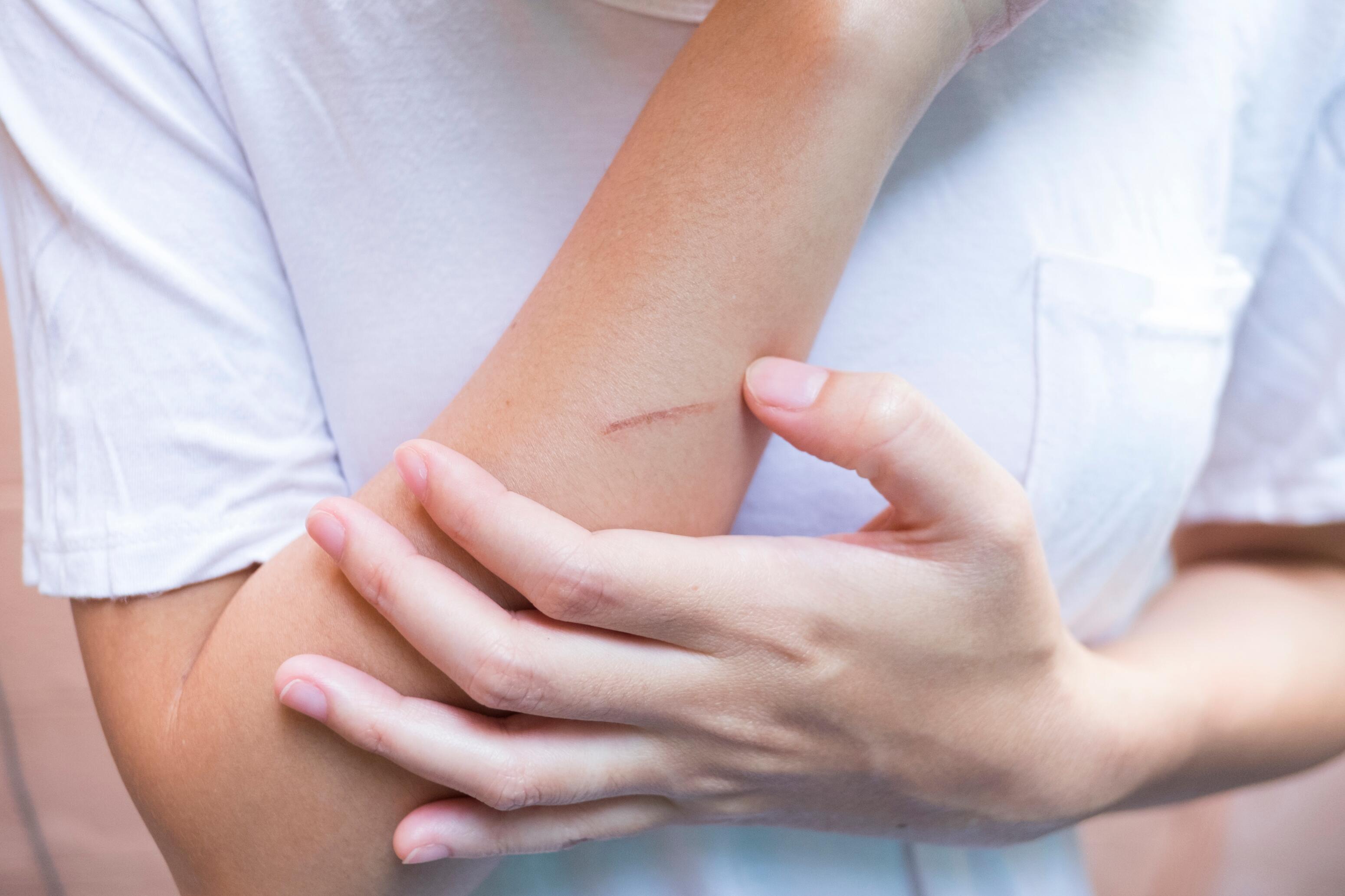 tout savoir sur les cicatrices